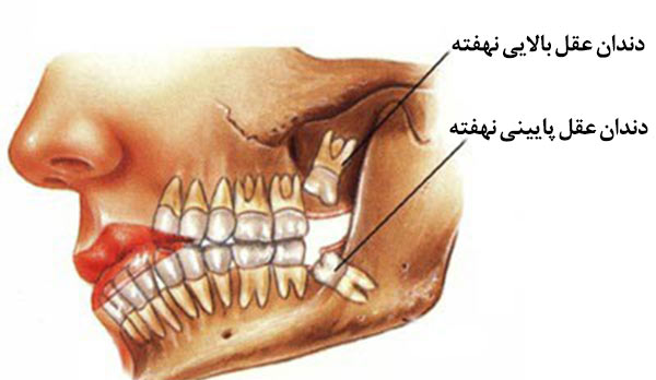 جراحی دندان های عقل - کلینیک مریم