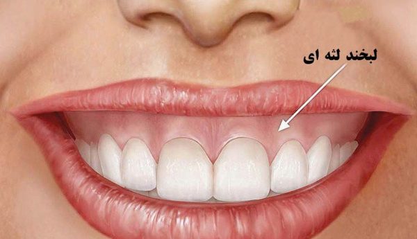 تغییر رنگ دندان و کاهش زیبایی- کلینیک مریم