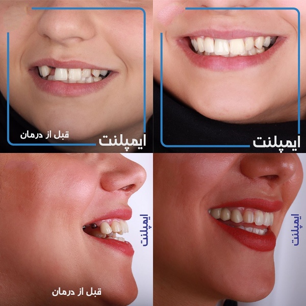 قبل ایمپلنت و بعد از ایمپلنت - کلینیک دندانپزشکی مریم