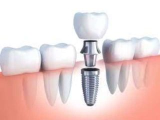 ایمپلنت دندان - کلینیک دندانپزشکی مریم
